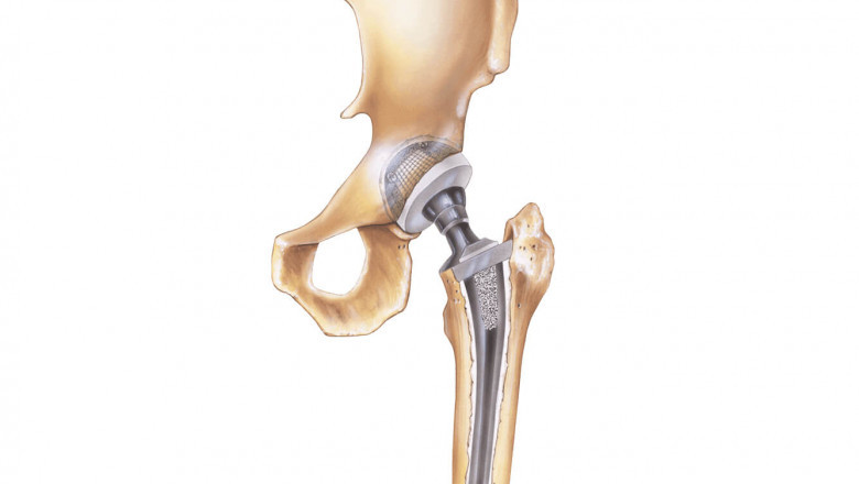 Global Hip Replacement Implant Market | In-depth Assessment, Crucial Trend, Industry Drivers, Future Projection by 2031