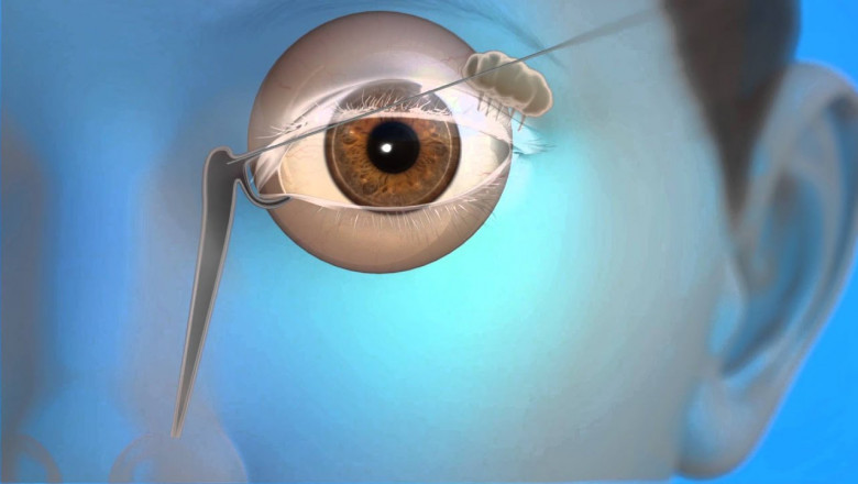 Global Nasal Lacrimal Stent Market Restraints