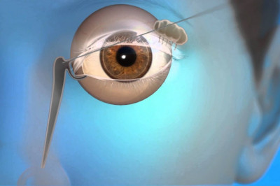 Global Nasal Lacrimal Stent Market Restraints