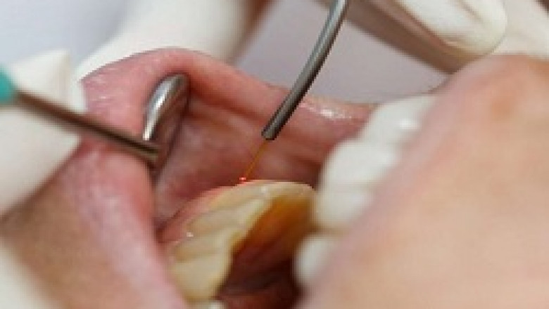 Is the Laser Root Canal Painless?