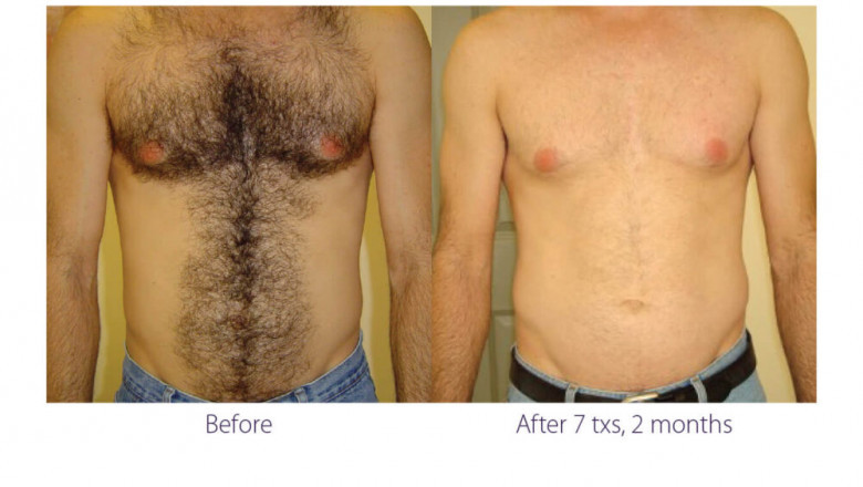 4 reasons why laser hair removal is the best option.
