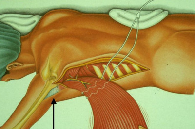 CARDIOMYOPLASTY : What is it, Types, Experience, and Risks | Heart Hospital in Lucknow