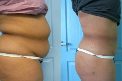 Best Liposuction Surgery in Delhi at Our Clinic