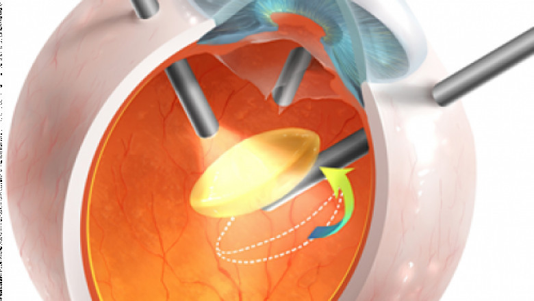 Follow the advice of an expert in the field of eyes