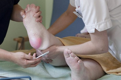 How Does Hypertension Affect Pressure Ulcers?