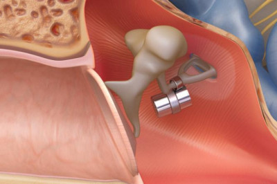 What are the Middle Ear Implants?