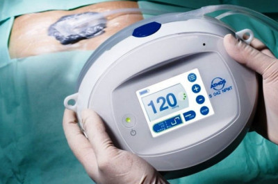 What are the Negative Pressure Wound Therapy (NPWT) Devices?