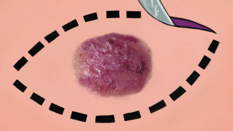 In Response To The Increasing Cases Of Melanoma As Well As Other Types Of Skin Cancer, Pharmacotherapy, Radiation Therapy, And Surgery Are Used In Melanoma Treatment