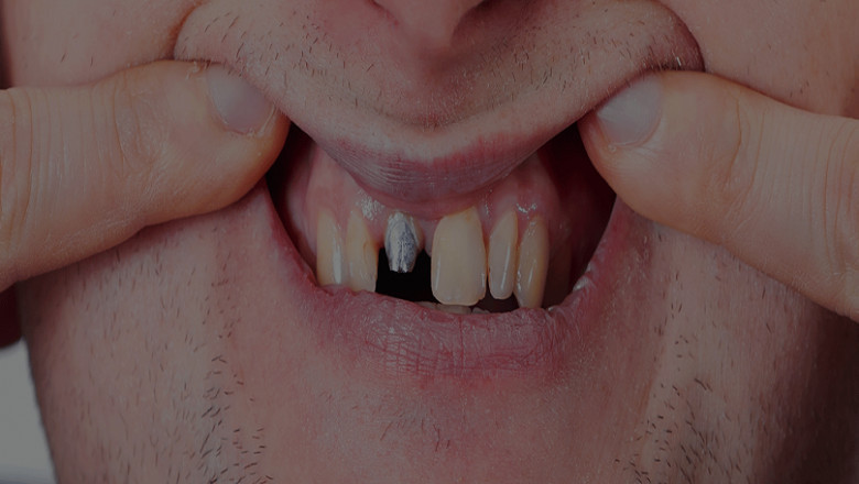 What Do You Know About All-on-4 Dental Implant Procedures?