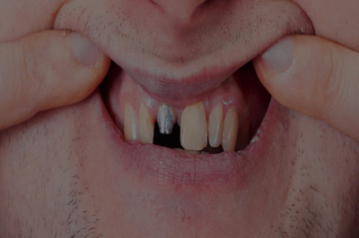 What Do You Know About All-on-4 Dental Implant Procedures?