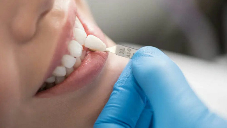 Why Do Dentists Use Dental Fillings?