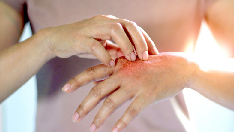Global Psoriasis Treatment Market Restraints