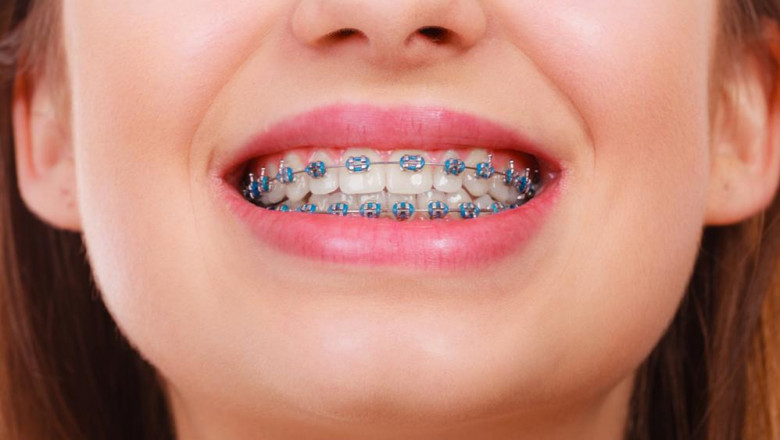 Market size, share, growth, opportunity, and trends in the dental braces market