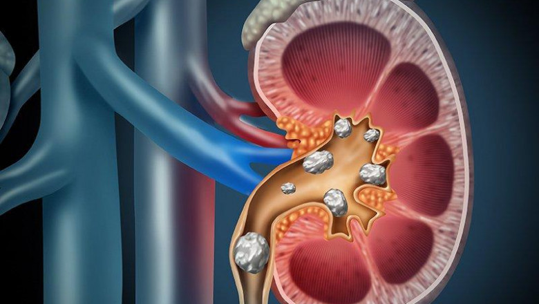 An analysis of the global urolithiasis management devices market, including trends, share, size, growth, opportunity, and challenges