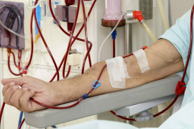Hemodialysis Involves Pumping Blood Out Of Blood Vessels, Purifying It With A Dialyzer