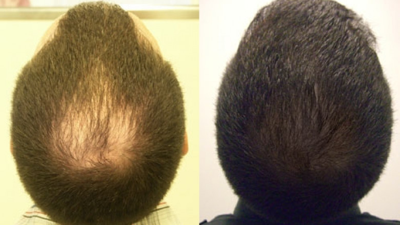 The Crown Hair Transplant Timeline
