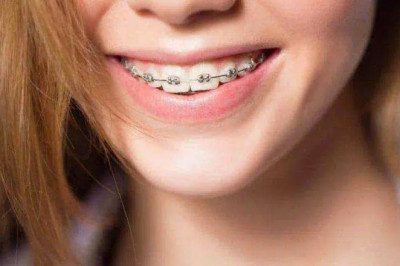 What Is Orthodontic Treatment? | Tower House Dental Clinic