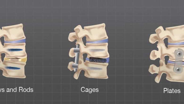 Anatomical Surgical Defects Of The Spine Can Be Corrected Using Spinal Non-Fusion Device