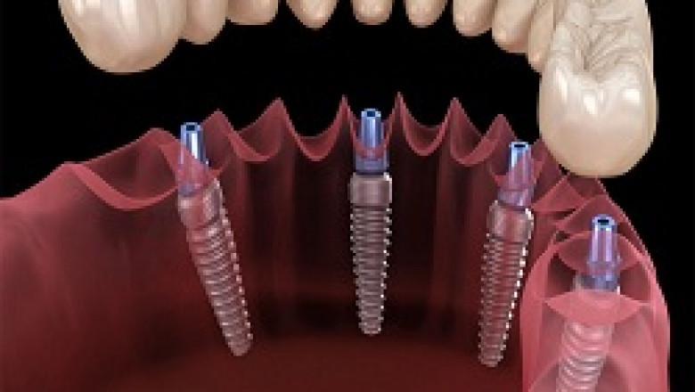 Dental bone graft