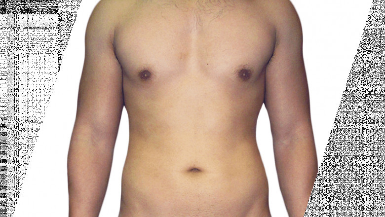 How Much Effective Is Vaser Liposuction?