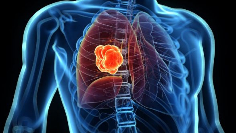 Lung Cancer Therapeutics Market Share and Growth Factors 2021–2027