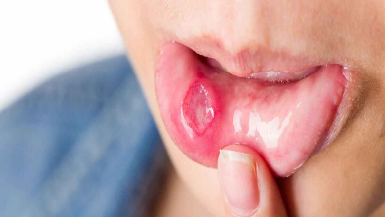 Mouth Ulcer Treatment Market In-Depth Analysis & Forecast 2019-2030