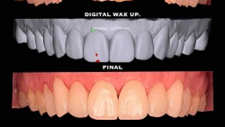 Why Do Dental Experts Perform Dental Implant Surgery?