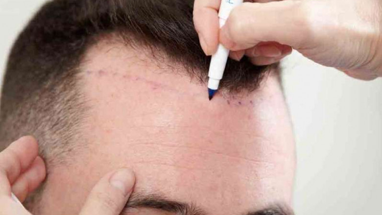 Hair Transplant Myths And Facts- Discussed