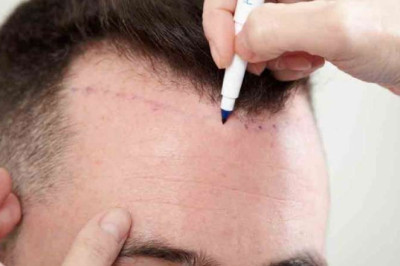 Hair Transplant Myths And Facts- Discussed