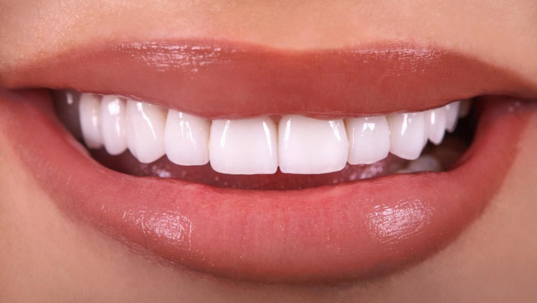 How Long Do Temporary Dental Fillings Last?