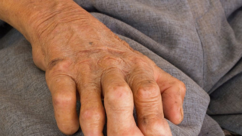 What is Leprosy Treatment?