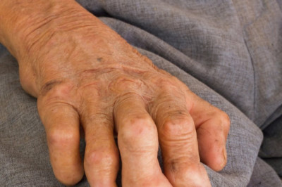 What is Leprosy Treatment?