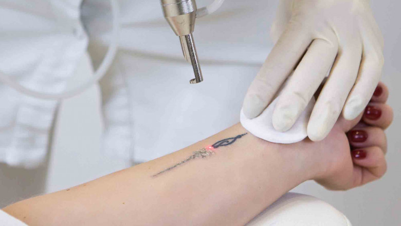 All about laser tattoo removal and 4 reasons why they might need to be removed