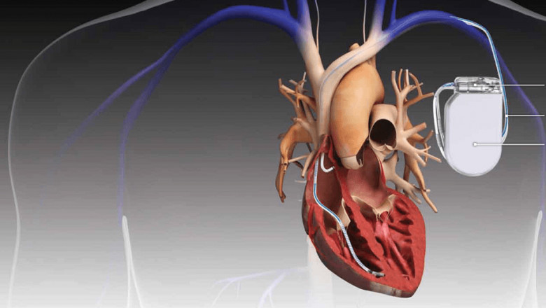 Global Implantable Cardioverter-defibrillators Market Restraints