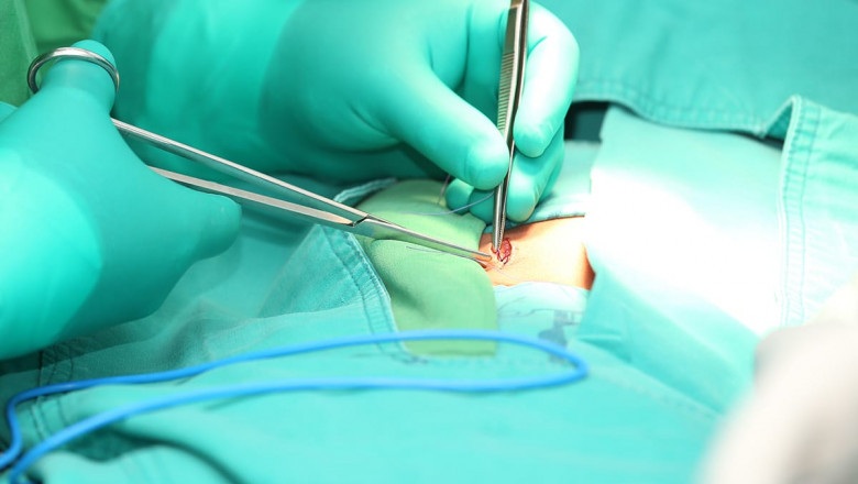 Hernia Repair Market Analysis 2022-2027, Industry Size, Share, Trends and Forecast