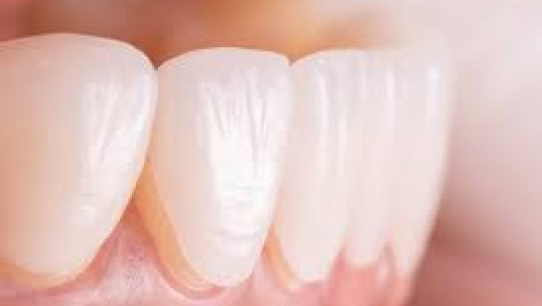 porcelain veneers for crooked teeth