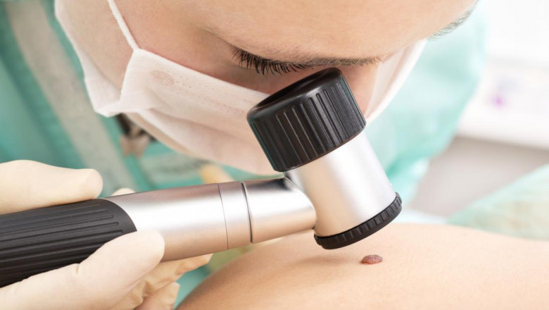 Melanoma Treatment Market Emerging Trend, Top Companies, Company Demand, Business Review and Regional Analysis by 2026