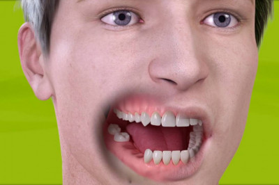 What Can I Have Instead of a Dental Implant?