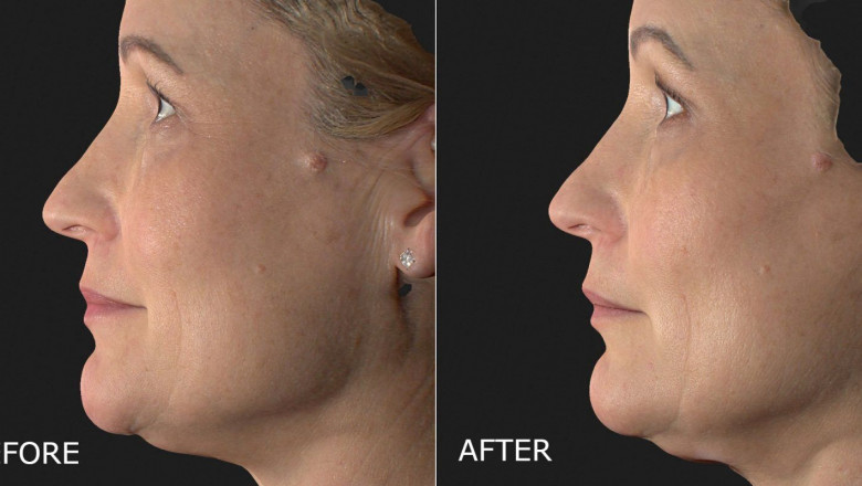 Advantages of opting for laser hair removal