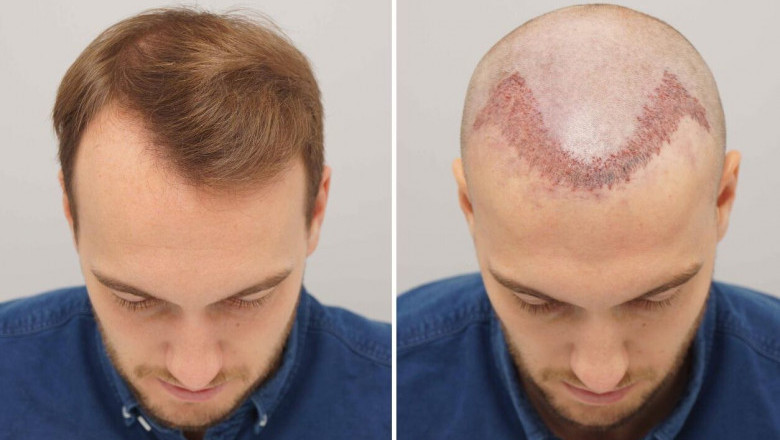 FUE vs. FUT Hair Transplant - What Are the Differences?