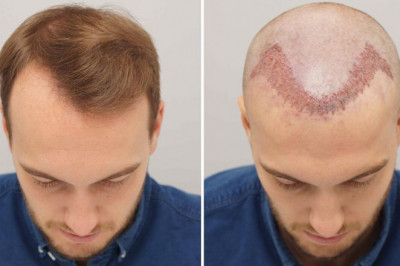 FUE vs. FUT Hair Transplant - What Are the Differences?