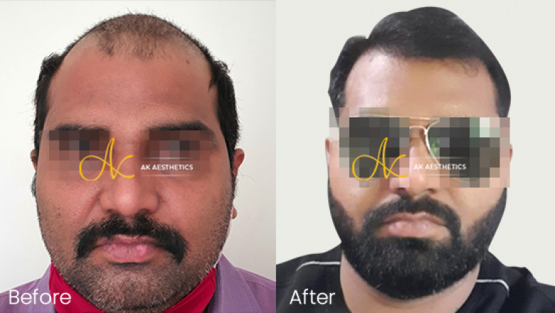Hair Transplant- Common Myths and Facts