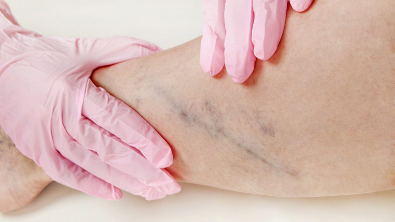 Most Patients Consider Microsclerotherapy Treatment To Be The Best Option