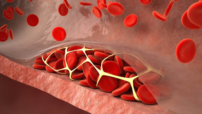 Prevention of Venous Thromboembolism