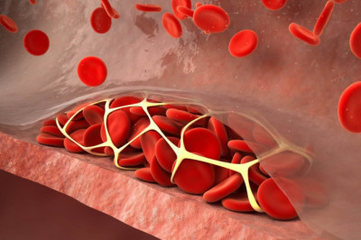 Prevention of Venous Thromboembolism