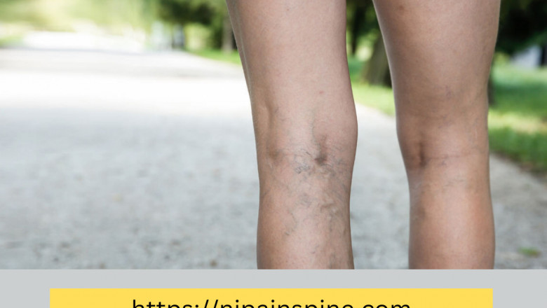 Spider Veins: Get To Know Them before They Get To You
