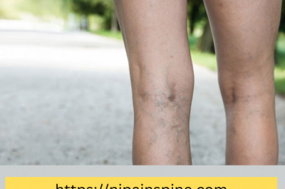 Spider Veins: Get To Know Them before They Get To You