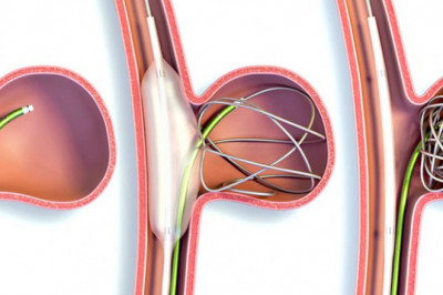 All You Need To Know About Atherectomy Devices And Its Types