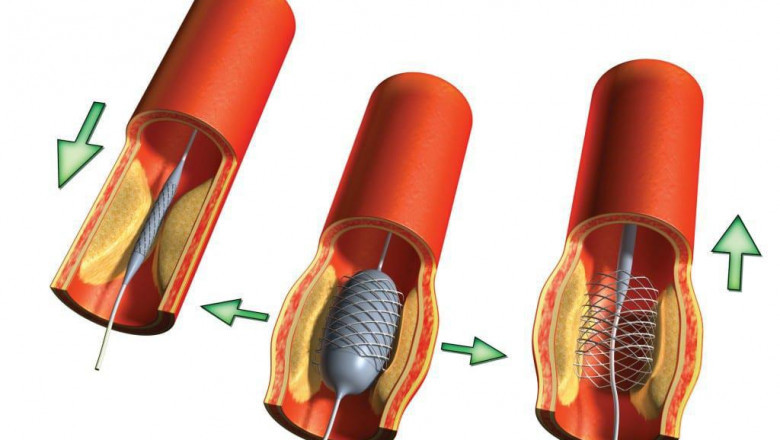 Angioplasty Balloons; Improve Blood Flow By Opening Narrowed Or Blocked Vessels