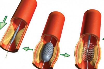 Angioplasty Balloons; Improve Blood Flow By Opening Narrowed Or Blocked Vessels